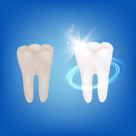 Realistic Detailed 3d Teeth Whitening Procedure Concept on a Blue. Vector illustration of Before and After Tooth Viewsのイラスト素材