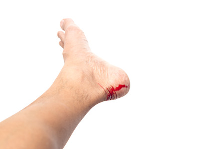 Feet injury breaking skin with bleeding blood isolated in white background clipping pathの写真素材