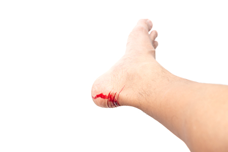 Feet injury breaking skin with bleeding blood isolated in white background clipping pathの写真素材
