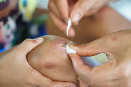 Mother clean and provides first-aid at wound on son leg.の写真素材