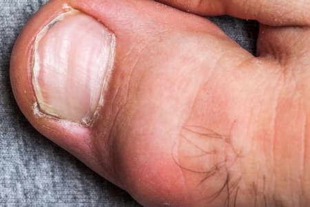 Mans toe and nail in bad condition close upの写真素材