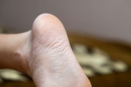 Closeup of woman feet sole with dry cracked skin. Foot and toes care concept.の写真素材