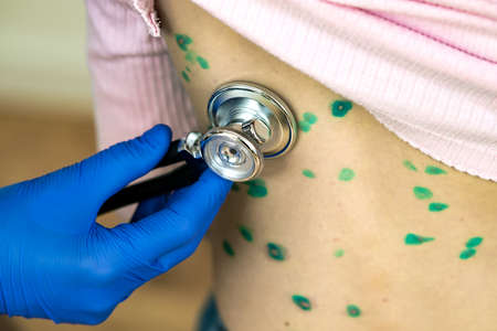 Doctor examining a child with stethoscope covered with green rashes on back ill with chickenpox, measles or rubella virus.の写真素材