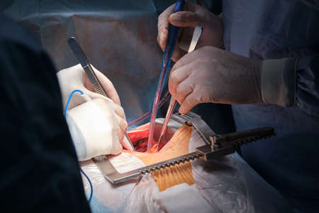 Closeup of professional doctor hands operating a patient during open heart surgery in surgical room. Healthcare and medical intervention conceptの写真素材