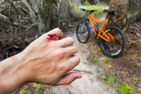 Bike rider hand injury with red blood from hitting a tree stump. Mountain biking accidentの写真素材