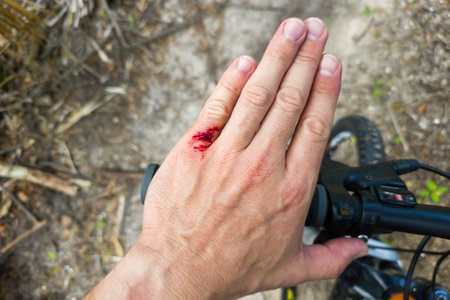 Arm injury while riding mountain bike on Florida jungle trails. Red bloody wound from hitting a tree stump. Biking accidentの写真素材