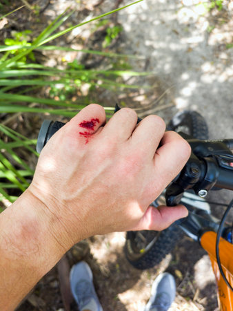Mountain bike rider hand wounded from hitting a tree stump on forest trail. Biking accidentの写真素材