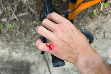 Arm injury while riding mountain bike on Florida jungle trails. Red bloody wound from hitting a tree stump. Biking accidentの写真素材