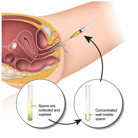 Intrauterine insemination pregnancy medical vector illustrationのイラスト素材