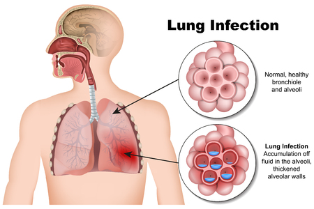Lung pneumonia infection 3d medical vector illustration on white backgroundのイラスト素材