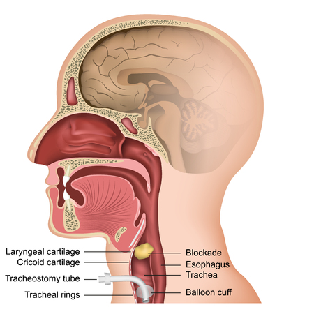 Tracheotomy medical vector illustration on white backgroundのイラスト素材
