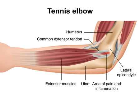 Tennis elbow injury medical vector illustration on white backgroundのイラスト素材