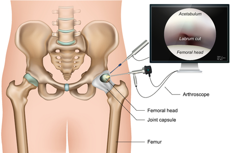 Hip arthroscopy 3d medical vector illustration on white backgroundのイラスト素材