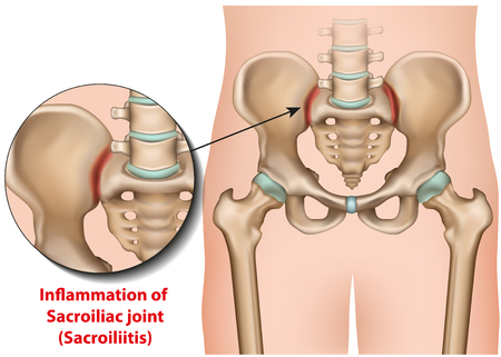 Sacroiliac joint inflammation 3d medical vector illustration sacroiliitisのイラスト素材