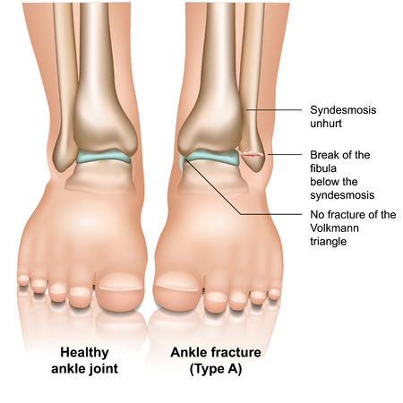 Ankle joint fracture type A medical vector illustration on white backgroundのイラスト素材