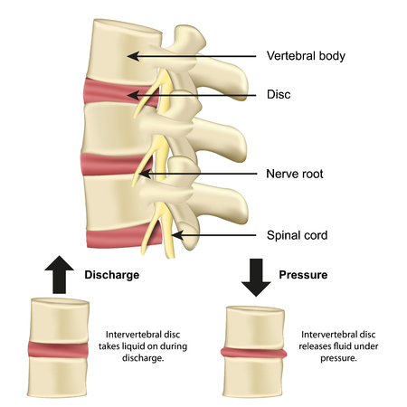 Vertebral body and disc anatomy and equipment on pressure medical vector illustration