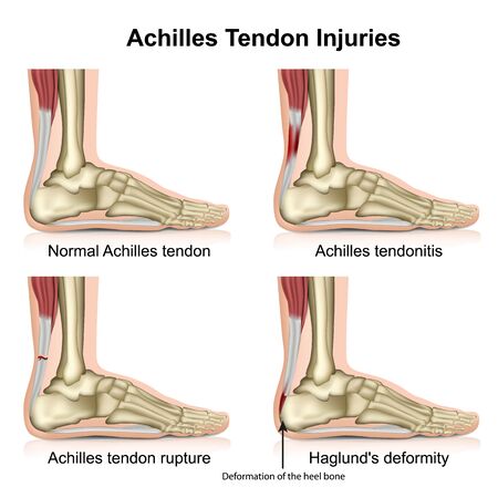 Achilles tendon injures medical illustration isolated on white background with english descriptionのイラスト素材