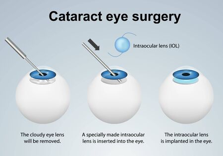 Cataract eye surgery process medical illustration isolated on gray backgroundのイラスト素材