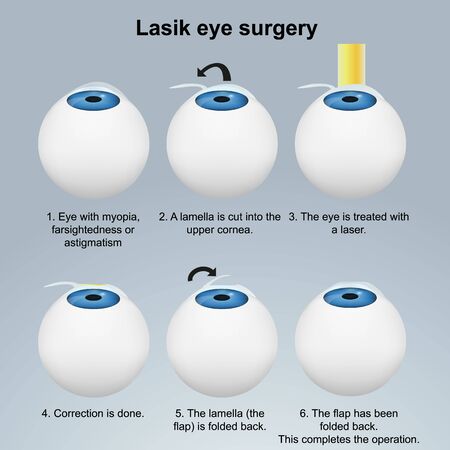 Lasik eye surgery medical illustration isolated on white backgroundのイラスト素材