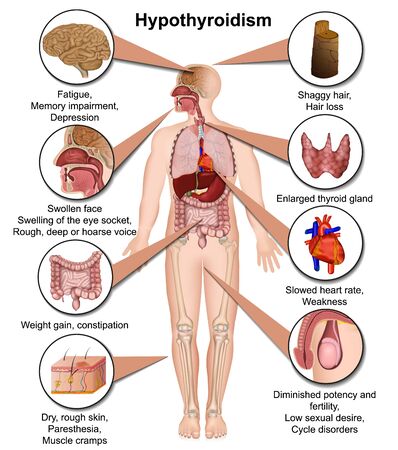 Hypothyroidism medical illustration isolated on white background infographicのイラスト素材