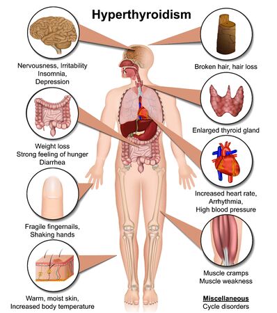 Hyperthyroidism medical illustration isolated on white background infographicのイラスト素材