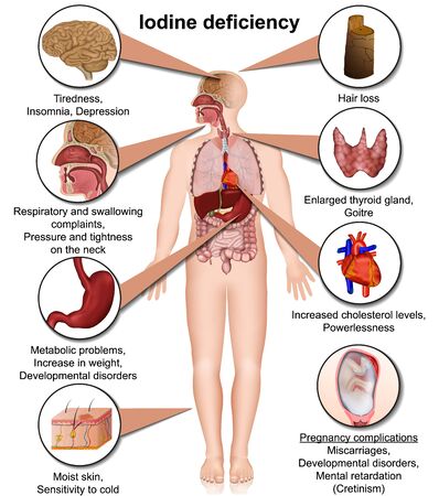 Iron deficiency effects on the body 3d medical vector illustration isolated on white background eps 10 infographicのイラスト素材