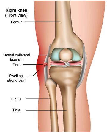 Lateral collateral tear 3d medical vector infographic isolated on white backgroundのイラスト素材