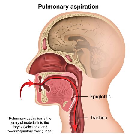 Pulmonary aspiration medical vector illustration isolated on white backgroundのイラスト素材