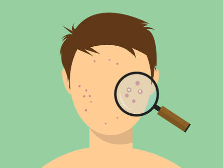 human male acne face with magnifying glass vector