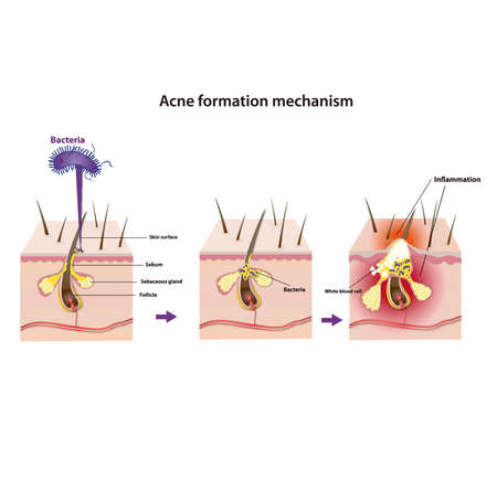 acne formation mechanismのイラスト素材