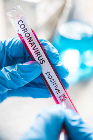 Conceptual photograph of a doctor's hands holding and marking a test tube as positive for the presence of coronavirus (COVID-19).の写真素材