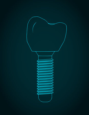 Stylized vector illustration of blueprint of dental prosthesisのイラスト素材