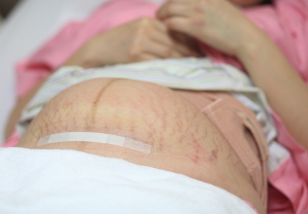 Pregnant belly stomach after birth operationの写真素材