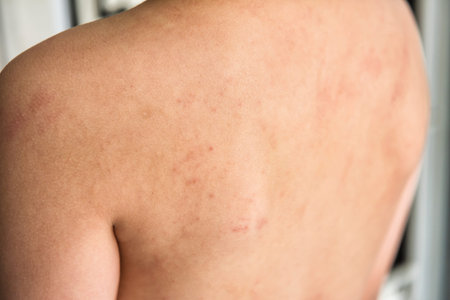 Closeup boy back with Eczema atopic dermatitis skin. Cow's milk protein allergy caused rash in...