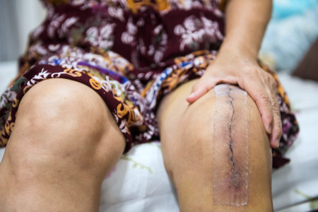Asian senior or elderly old woman patient show her scars surgical total knee joint replacement Suture wound with tape. Recovery after surgery. healthy arthroplasty concept.の写真素材