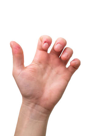 White Caucasian female hand in a light grip position showing off bitten fingers from Dermatophagia disorder isolated against pure white background 2020の写真素材