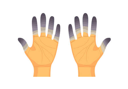 Frostbite fingers vector illustration on white background. Palm injured in winter.のイラスト素材