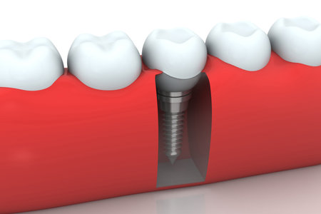     Dental implant , human Tooth	