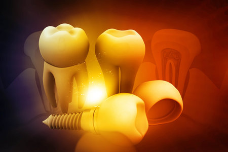 Dental implant concept on beautiful background