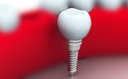 3d render of Dental implant , human Toothの写真素材