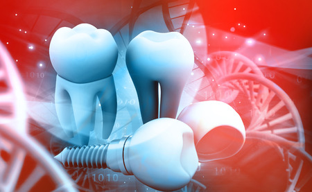 Tooth human implant. 3d illustrationの写真素材