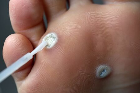 Warts on the leg.