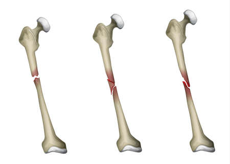 Three types of bone fracture in the femur