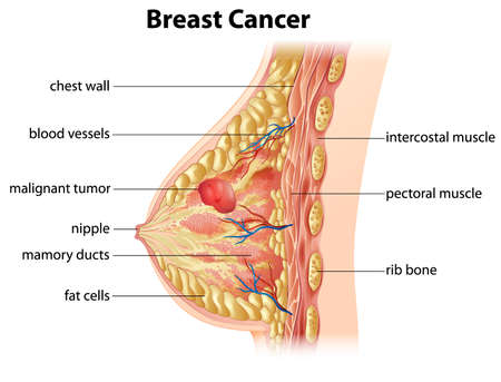Cross section showing formation of breast cancerのイラスト素材