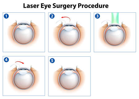 Illustration showing a laser eye surgery procedureのイラスト素材