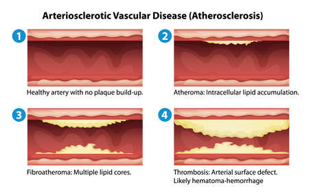 Illustration showing the process of ateriosclerosisのイラスト素材