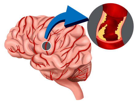 Illustration of a Blood Clot concept in the brain on a white backgroundのイラスト素材