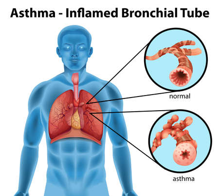 An image showing the asthma-inflamed bronchial tube on a white backgroundのイラスト素材