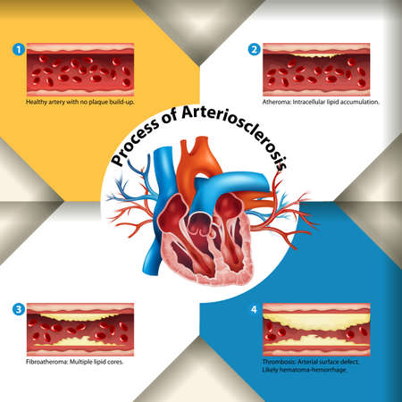Process of Arteriosclerosis poster illustrationのイラスト素材