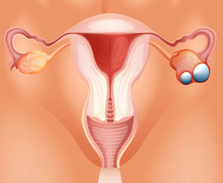 Overian cancer diagram in detail illustration